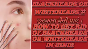 BLACKHEADS OR WHITEHEADS से छुटकारा कैसे पाएं । HOW TO GET RID OF BLACKHEADS OR WHITEHEADS IN HINDI
